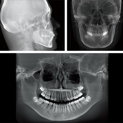 HiRes-3D-Tomografía-Computerizada-de-Haz-Conico